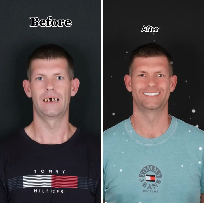 Man showing dramatic before and after dental work transformation with a confident, bright smile in after photo.