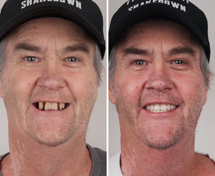 Before and after dental work transformation showing a man confidently smiling with improved teeth and oral health.
