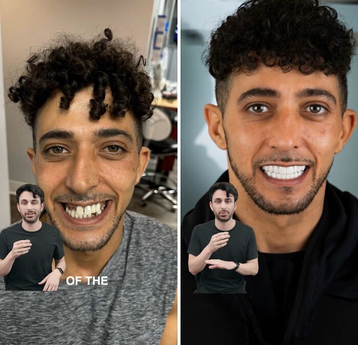 Before and after dental work showing a man’s smile transformation with improved teeth and confidence.
