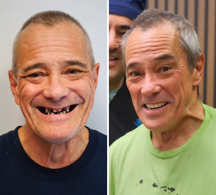 Before and after dental work transformation showing a man smiling confidently with improved teeth and oral health.