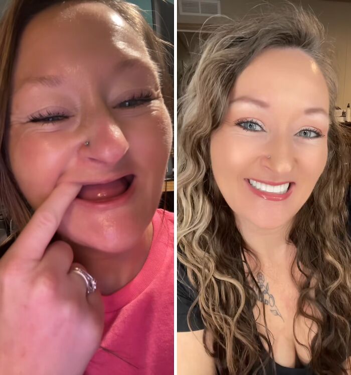 Before and after dental work transformation showing a woman smiling confidently with improved teeth.