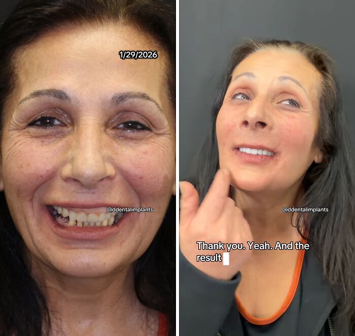 Before and after dental work showing a woman smiling confidently with improved teeth and no hesitation or shame.