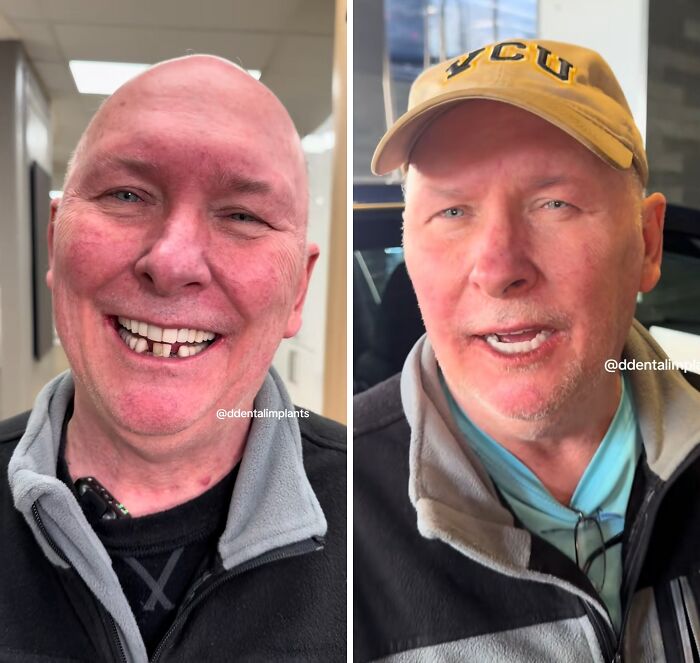 Before and after dental work transformation showing a man smiling confidently with improved teeth and dental implants.