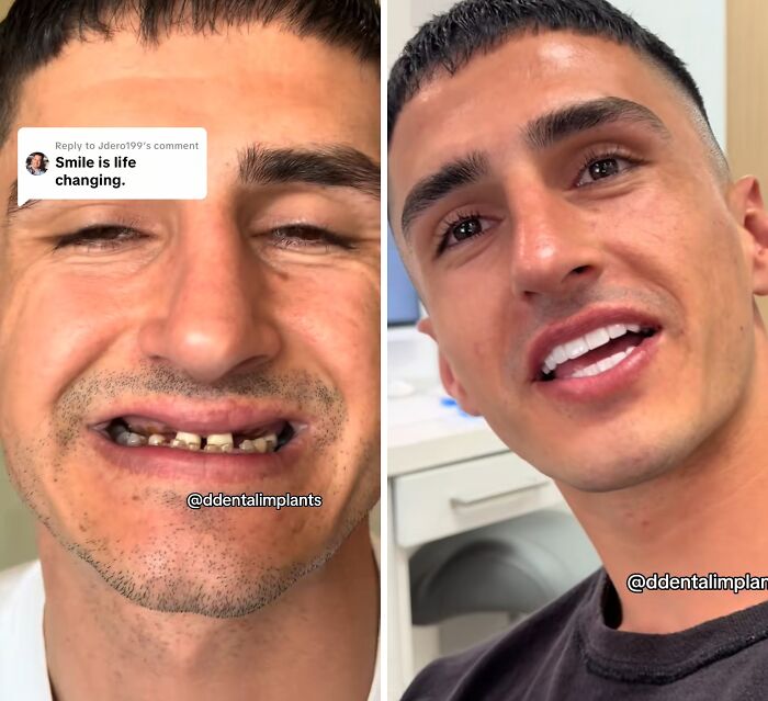 Before and after dental work transformation showing a man confidently smiling with improved teeth and dental work results.