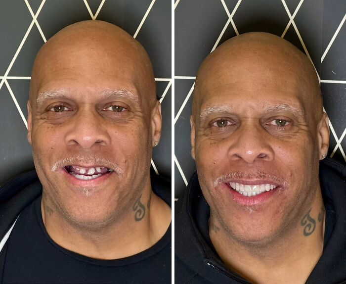 Before and after images of dental work showing a man’s smile transformation with improved teeth and confidence.