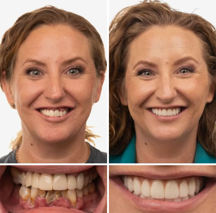 Before and after dental work showing a woman’s smile transformation with improved teeth and confidence.