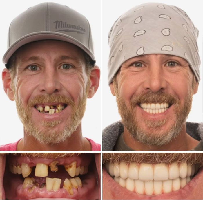 Before and after dental work transformation showing a man smiling with restored teeth, highlighting dental work results.
