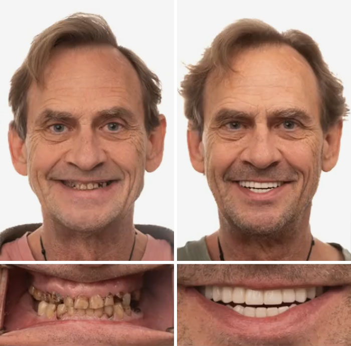 Before and after dental work transformation showing improved smile and clean, white teeth in close-up and portrait views.