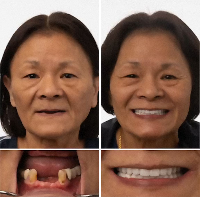 Before and after dental work showing a woman’s smile transformation with improved teeth and confidence.