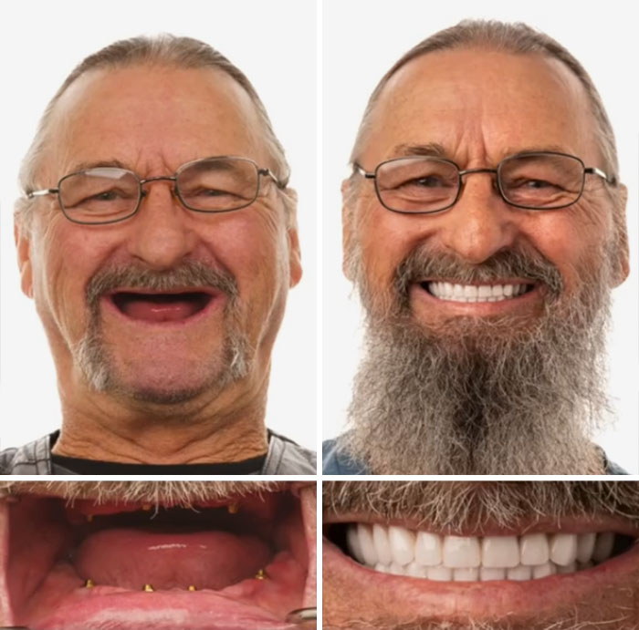 Before and after dental work showing a man smiling confidently with new teeth, illustrating dental work that made people smile.