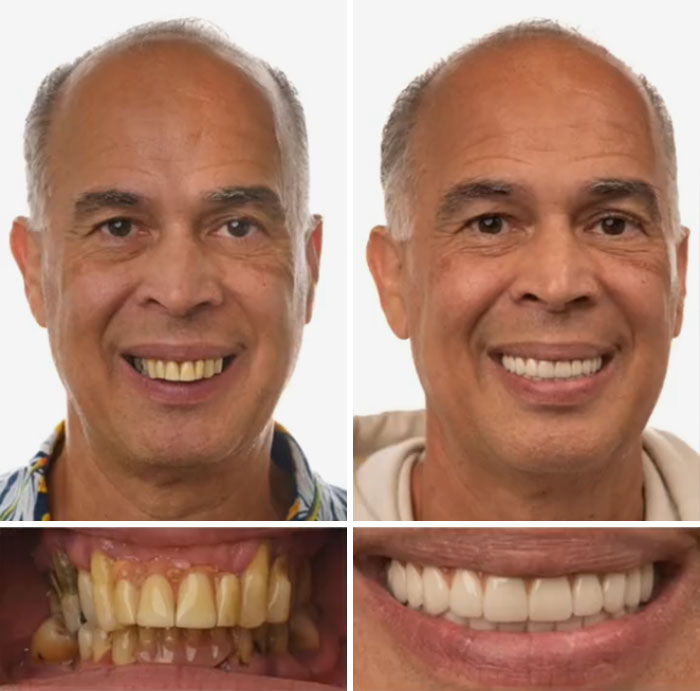Before and after dental work transformation showing improved smile and teeth restoration that made people smile confidently.