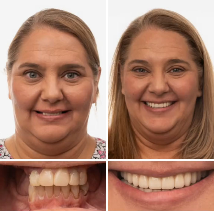 Before and after images of dental work showing improved smile and teeth transformation that boost confidence and dental health.