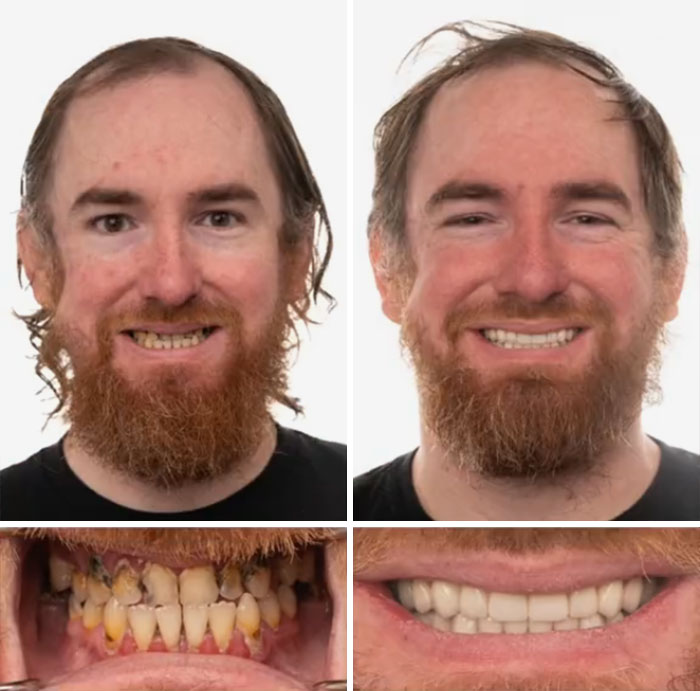 Before and after dental work showing a man’s smile transformation with improved teeth and confidence.