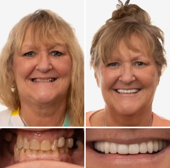 Before and after dental work showing improved smiles and teeth transformation that made people smile confidently.