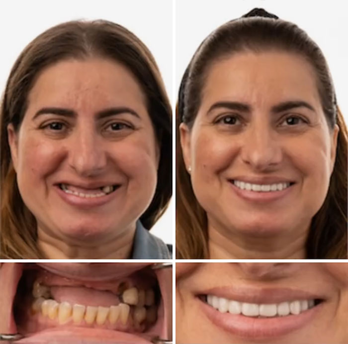 Before and after dental work transformation showing a smiling woman with improved teeth enhancing her confidence.