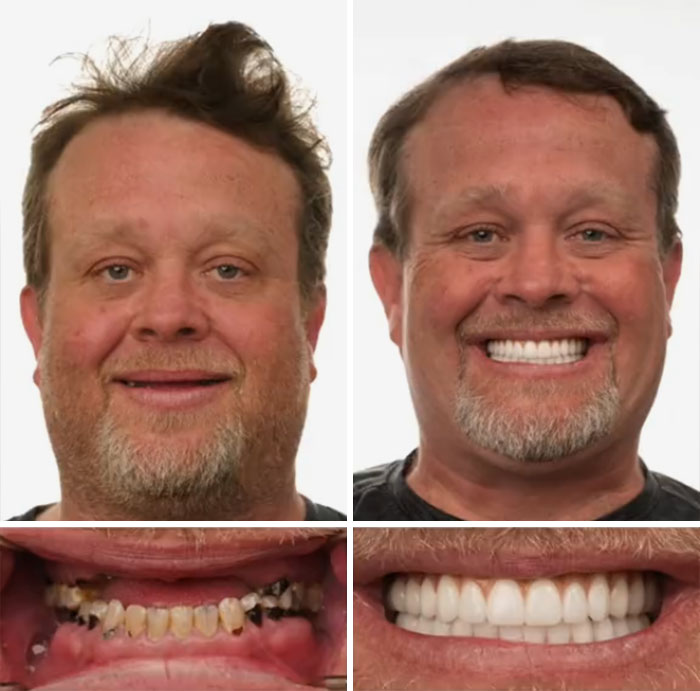 Before and after dental work transformation showing a man smiling confidently with improved teeth.