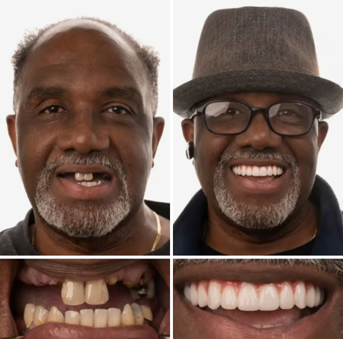 Before and after dental work transformation showing confident smile with improved teeth and dental restoration.