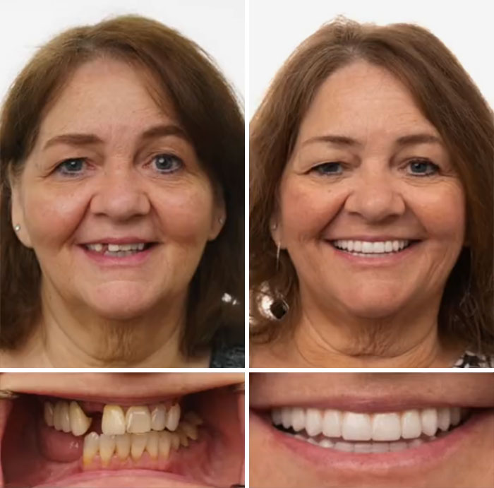 Before and after dental work transformation showing improved teeth and a confident smile without hesitation or shame.