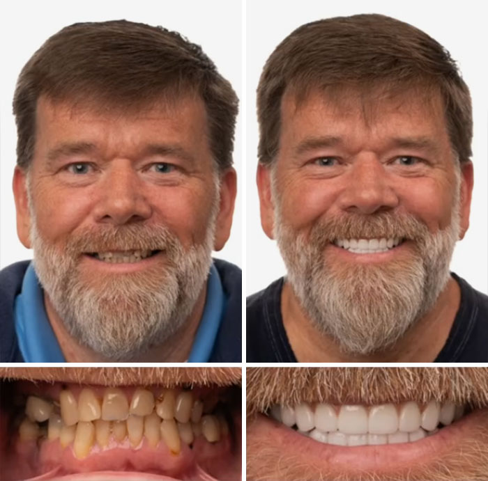 Before and after dental work showing a man smiling confidently with improved teeth and dental restoration results.