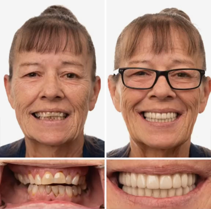 Before and after dental work showing a transformative smile improvement with new, bright, and even teeth.