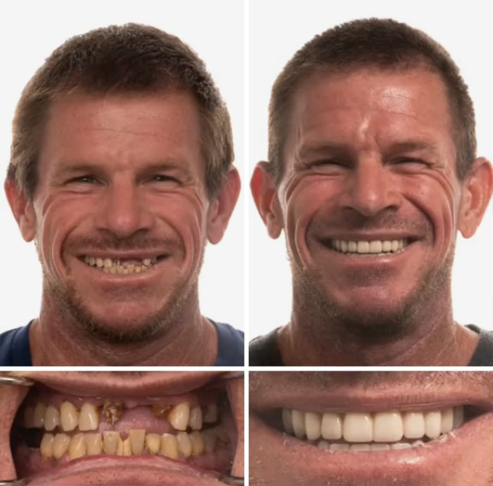 Before and after dental work transformation showing a man smiling confidently with restored teeth and improved smile.