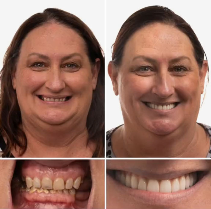 Before and after dental work photos showing a woman smiling confidently with improved teeth and dental health.