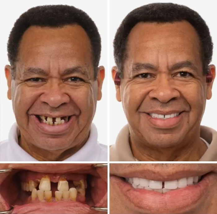 Before and after dental work showing a man smiling confidently with improved teeth in a dental transformation.