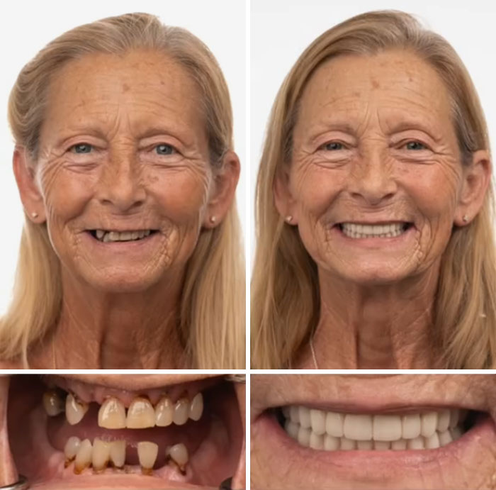 Before and after dental work showing a smiling woman with improved teeth and a confident smile transformation.
