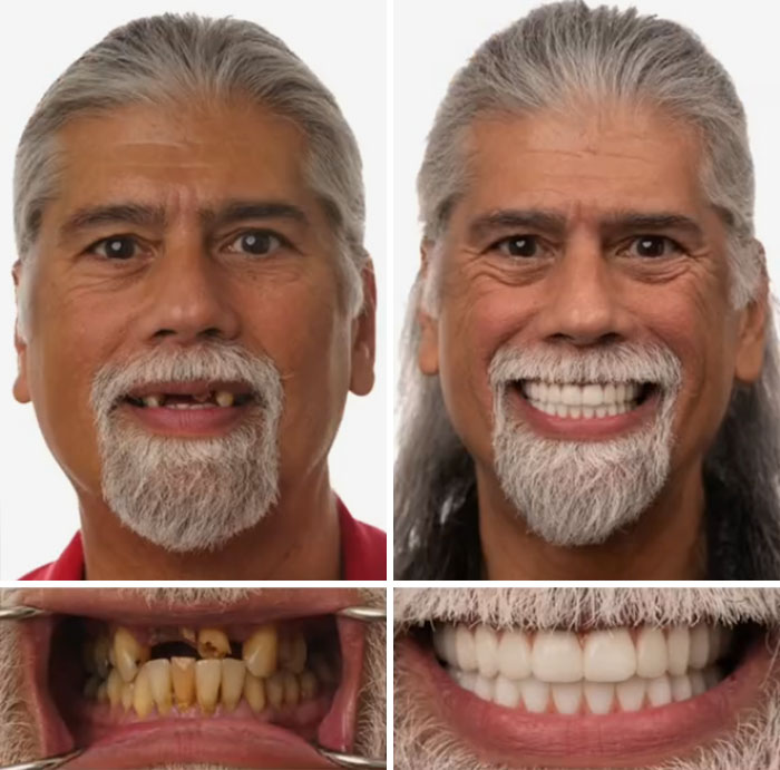 Before and after images of dental work transformation showing a man smiling confidently with new teeth.