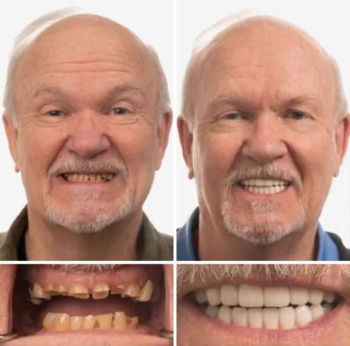 Before and after dental work on an elderly man showing improved teeth and a confident smile without hesitation or shame.