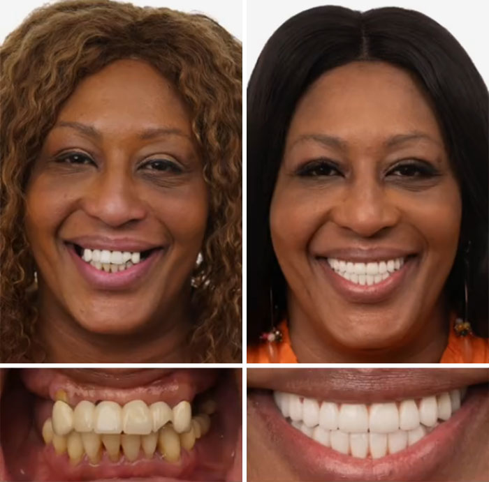 Before and after dental work showing a woman with improved teeth, highlighting confident smiles from dental work results.