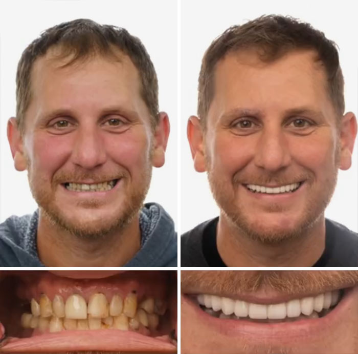 Before and after dental work showing a man smiling confidently with improved teeth and oral health results.