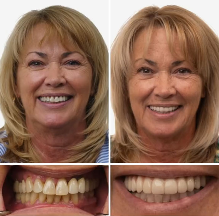 Before and after images of dental work showing improved smiles and dental restoration results for confident smiles.