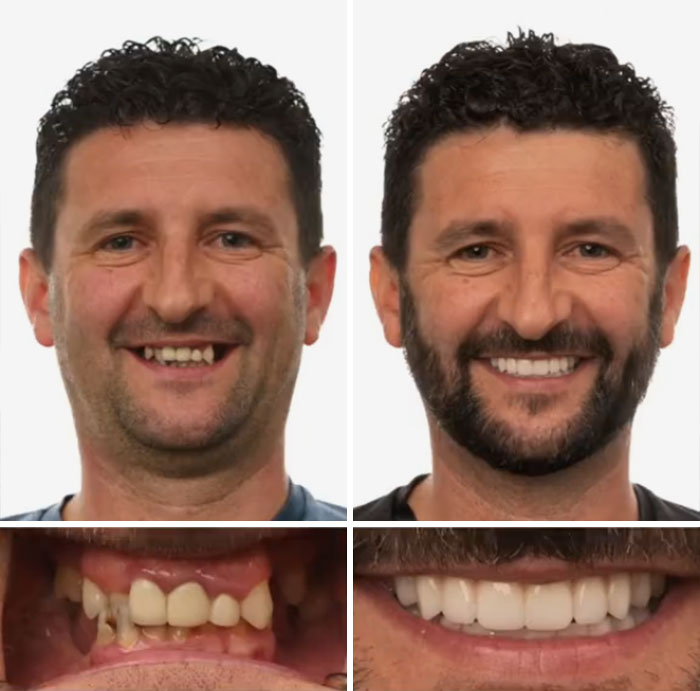 Before and after dental work showing a man with a transformed smile and improved dental appearance.