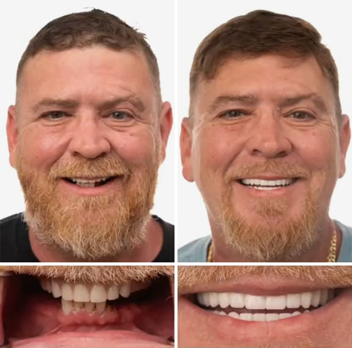 Before and after dental work photos showing a man smiling confidently with improved teeth in a dental transformation.