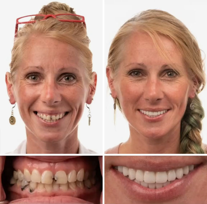 Before and after dental work showing a woman smiling confidently with improved teeth and a flawless smile.
