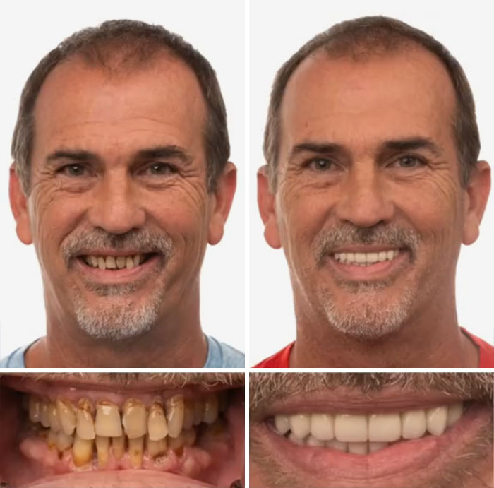 Before and after dental work transformation showing improved smile with clean, healthy teeth that made people smile without hesitation and shame.