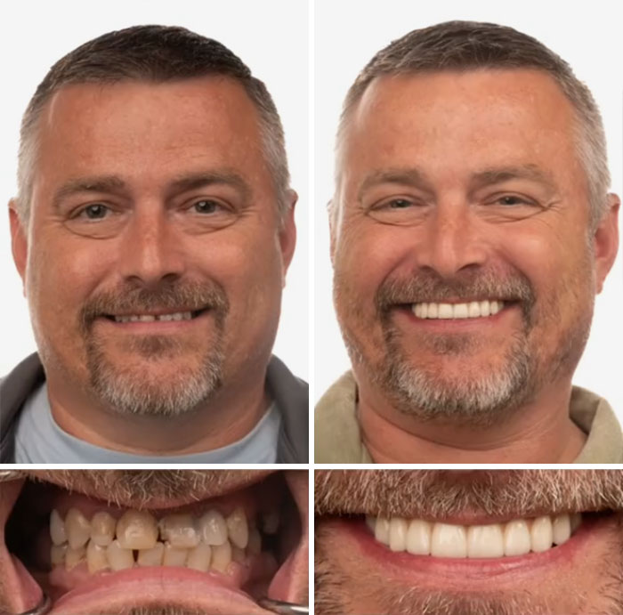 Before and after dental work on a middle-aged man showing a confident smile with improved teeth and oral health.