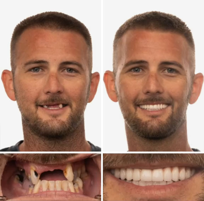 Before and after dental work transformation showing a man smiling confidently with improved teeth and dental work results.