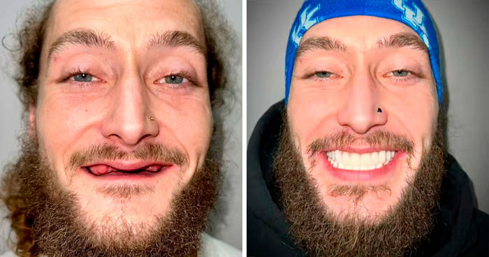 53 Dental Work That Made People Smile Without Hesitation And Shame