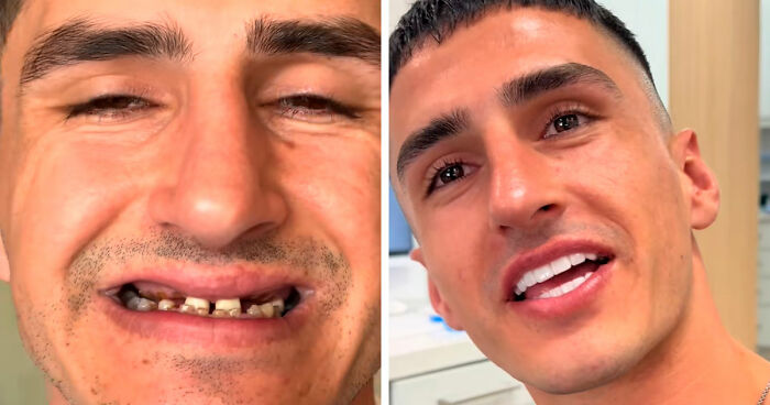 53 Dental Work That Made People Smile Without Hesitation And Shame