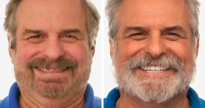 53 Dental Work That Made People Smile Without Hesitation And Shame