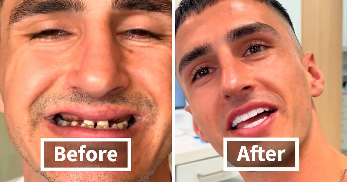 53 Dental Before-And-Afters That Prove Teeth Can Change Your Whole Appearance