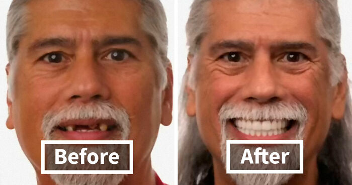 53 Dental Work That Made People Smile Without Hesitation And Shame