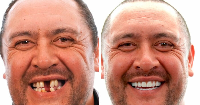 53 Dental Work That Made People Smile Without Hesitation And Shame