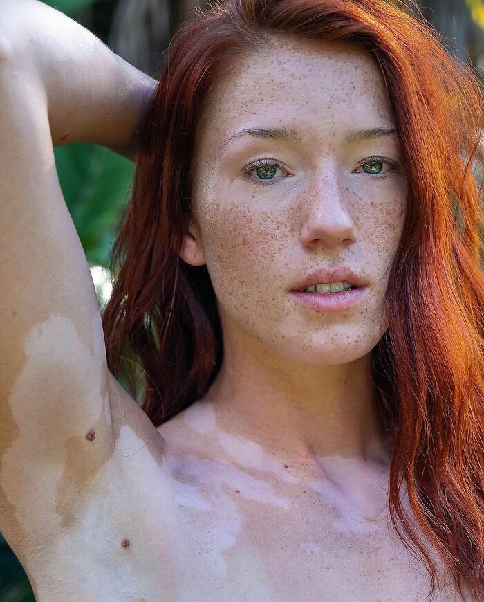 These People With Vitiligo Are Turning Their Skin Into Living Art (35 Pics)
