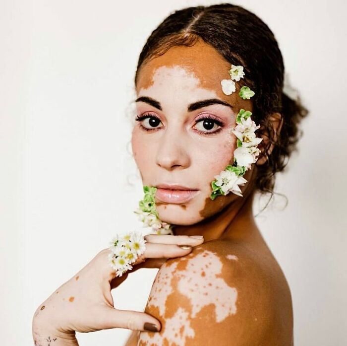 These People With Vitiligo Are Turning Their Skin Into Living Art (35 Pics)