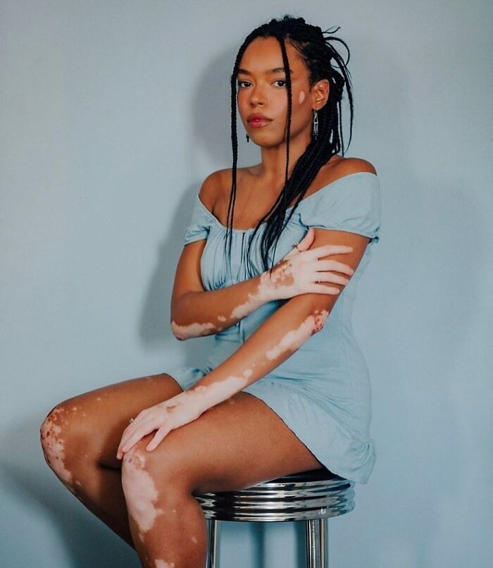 These People With Vitiligo Are Turning Their Skin Into Living Art (35 Pics)