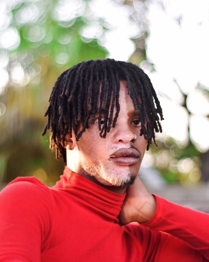 These People With Vitiligo Are Turning Their Skin Into Living Art (35 Pics)