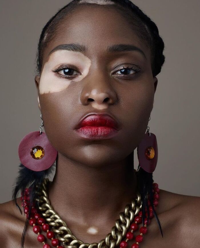 These People With Vitiligo Are Turning Their Skin Into Living Art (35 Pics)